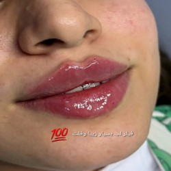 ژل و بوتاکس وتتو آبرو 