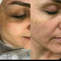 برداشتن خال و زگیل تناسلی