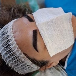  پیوندکاشت ابرو