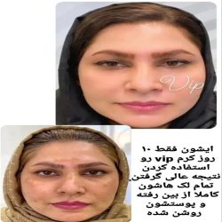 کرم ضدلک و سفید کننده 